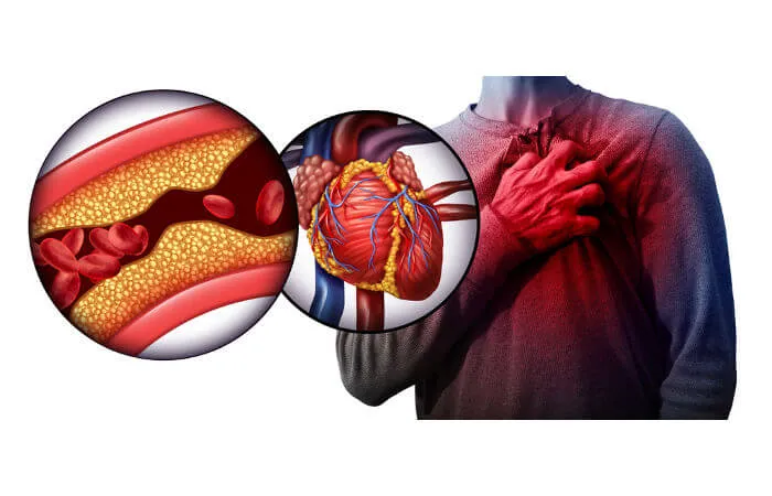 Problemas articulares podem causar infartos